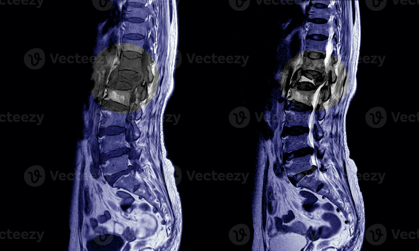 mri do a lombossacral coluna. foto