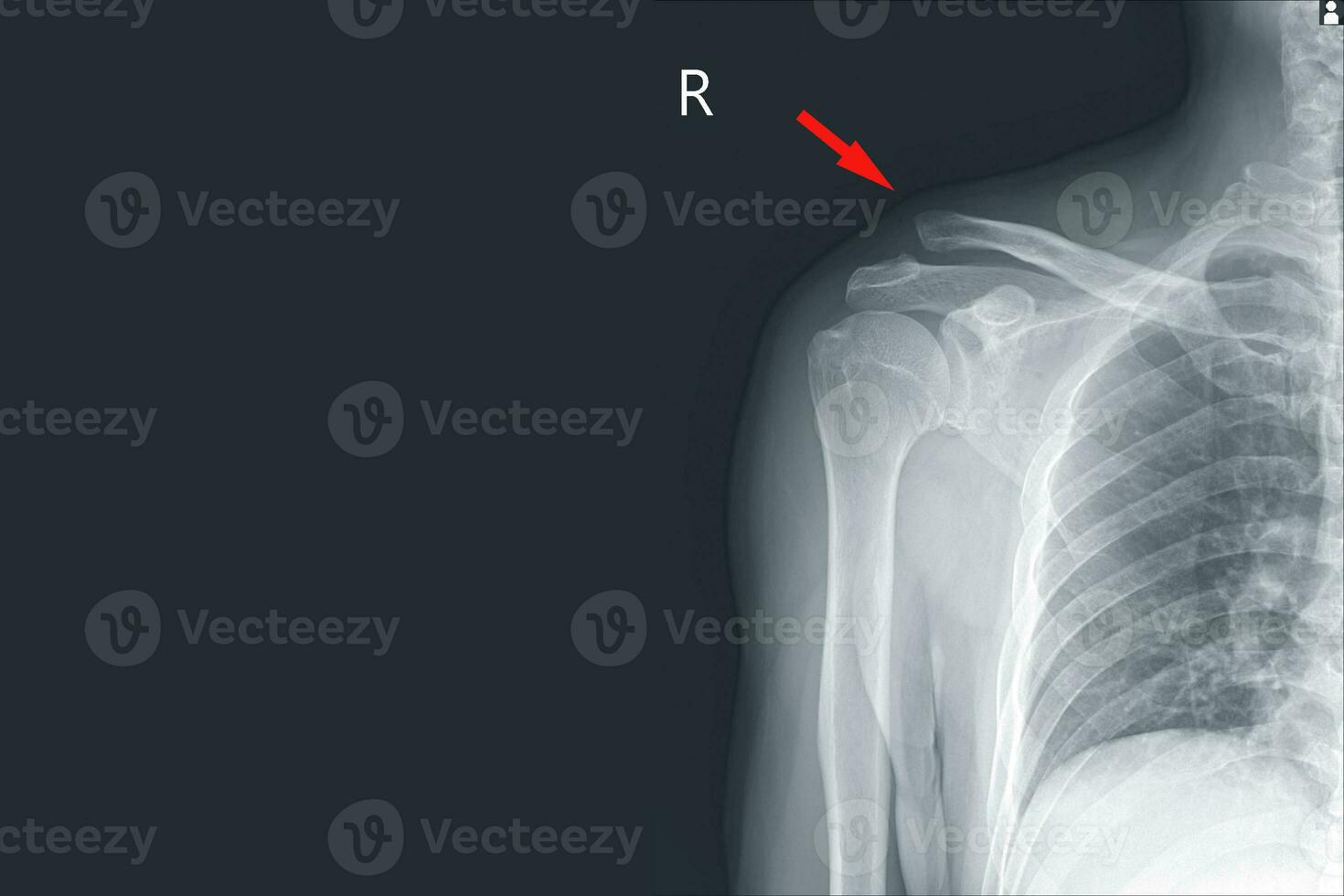 raio X certo ombro subluação do rt.acromioclavicular articulação prejuízo ,moderado inchaço do suave tecido. médico imagem conceito. foto