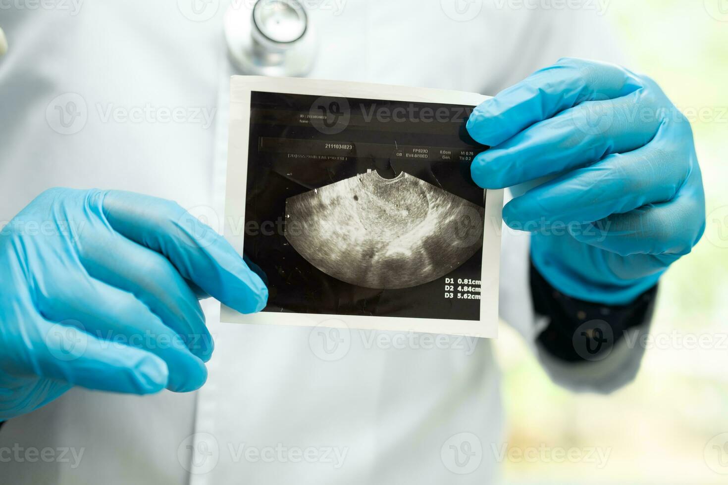 útero e ovário, médico segurando anatomia modelo e ultrassom cenário para estude diagnóstico e tratamento dentro hospital. foto