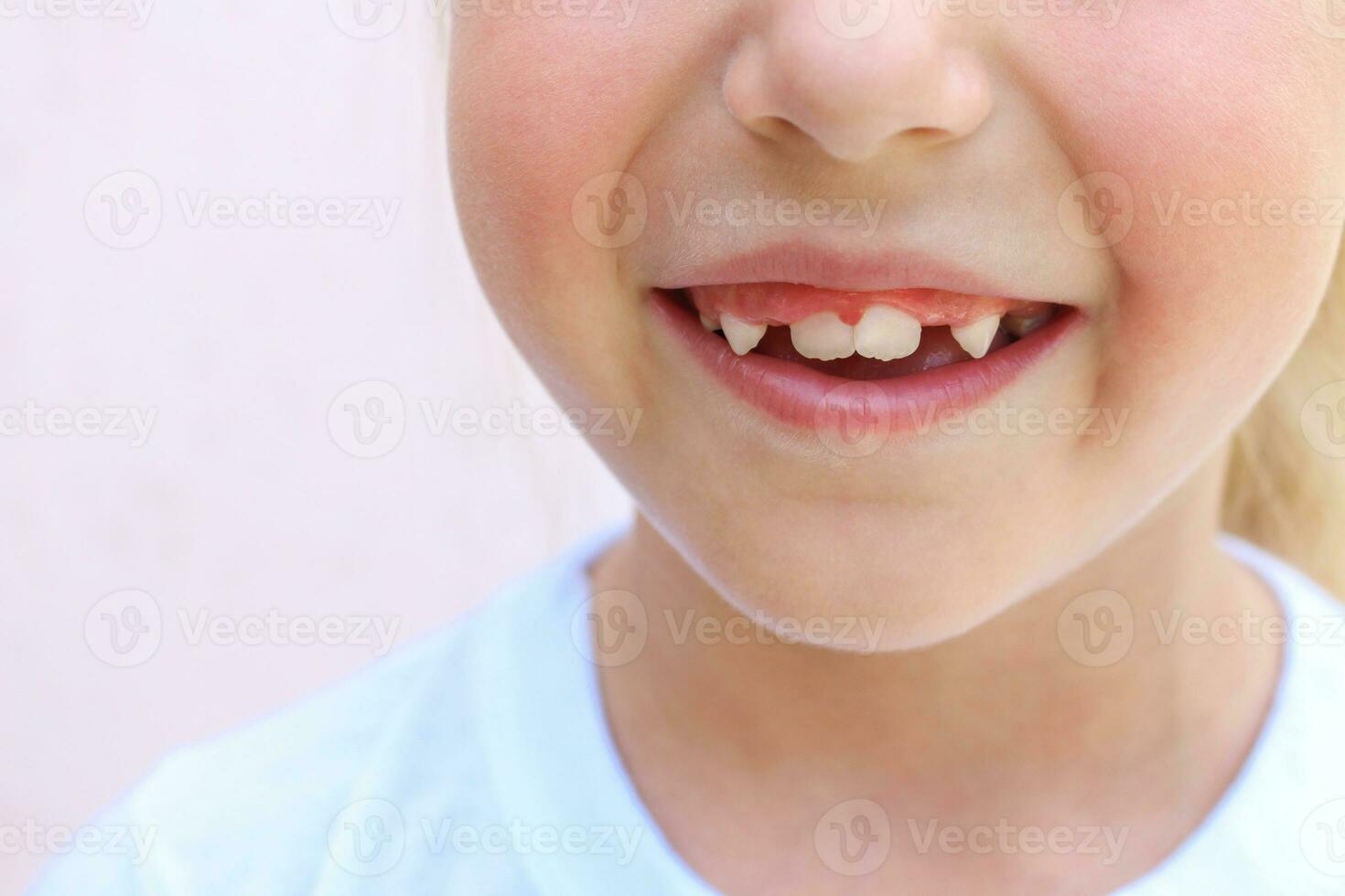 criança tem torto dentes. bebê dentes caiu fora. foto