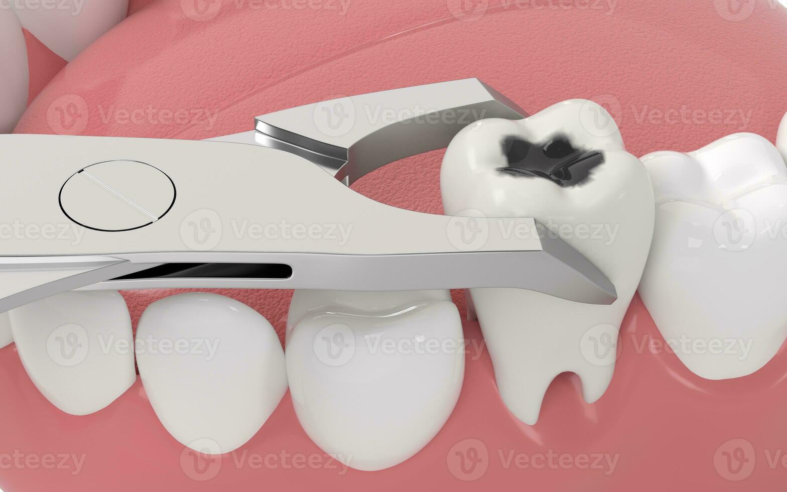 dente decair, pouco saudável dentes, 3d Renderização. foto