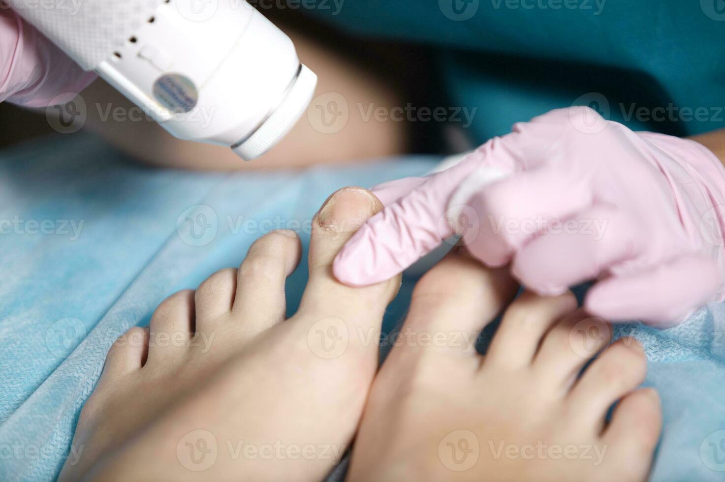 mulher recebendo laser tratamento em dela pés foto