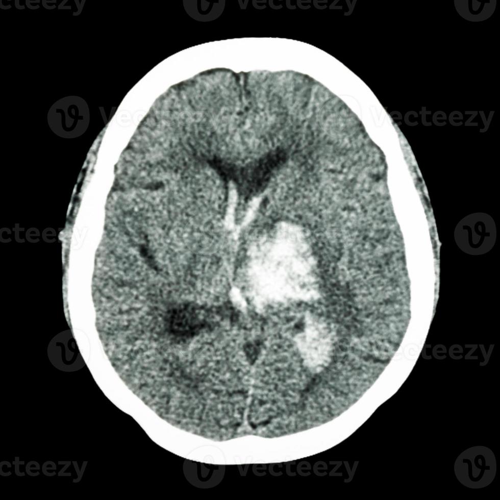 ct cérebro mostra hemorragia talâmica esquerda foto