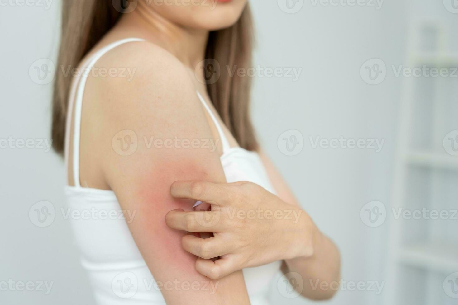 problema de pele e beleza. corpo de arranhar jovem tem coceira na pele de pele alérgica, alergia a esteróides, pele sensível, vermelha de queimadura solar, alergia química, erupção cutânea, picadas de insetos, dermatite seborreica. foto