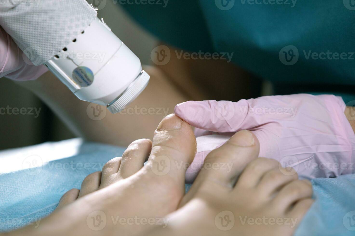 podólogo tratando onicomicose com uma laser foto