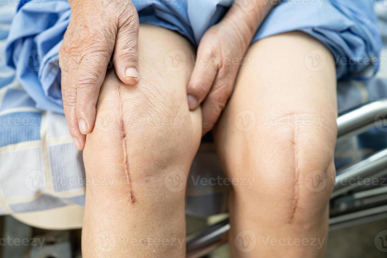 paciente idosa asiática mostra cicatrizes cirúrgicas na articulação total do joelho foto