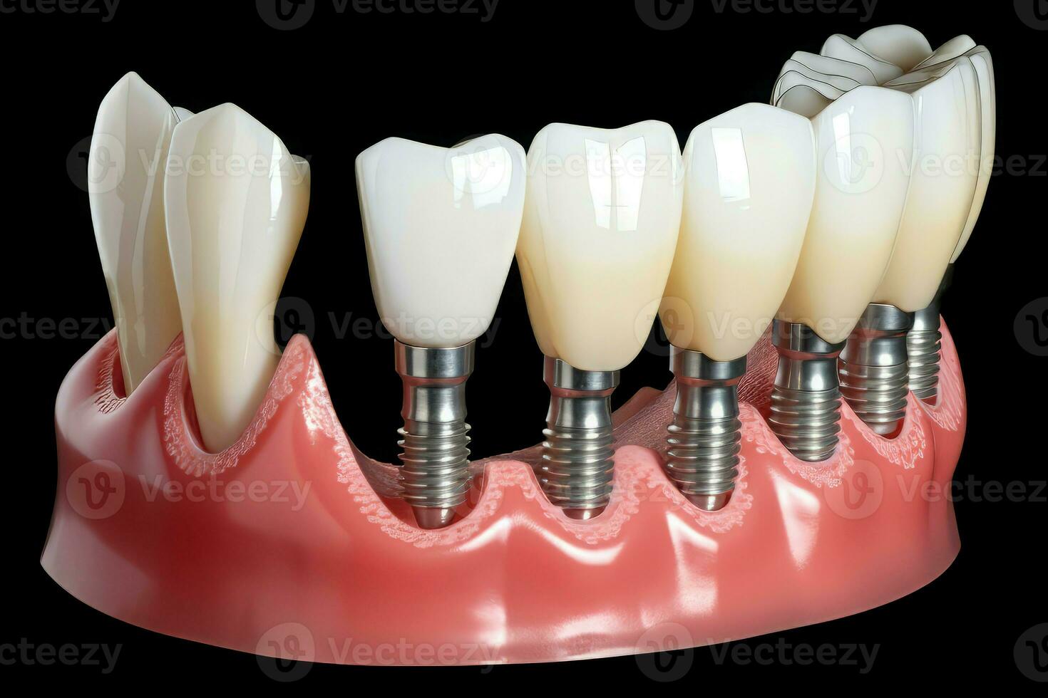 dental implantar tratamento Cuidado oral. gerar ai foto