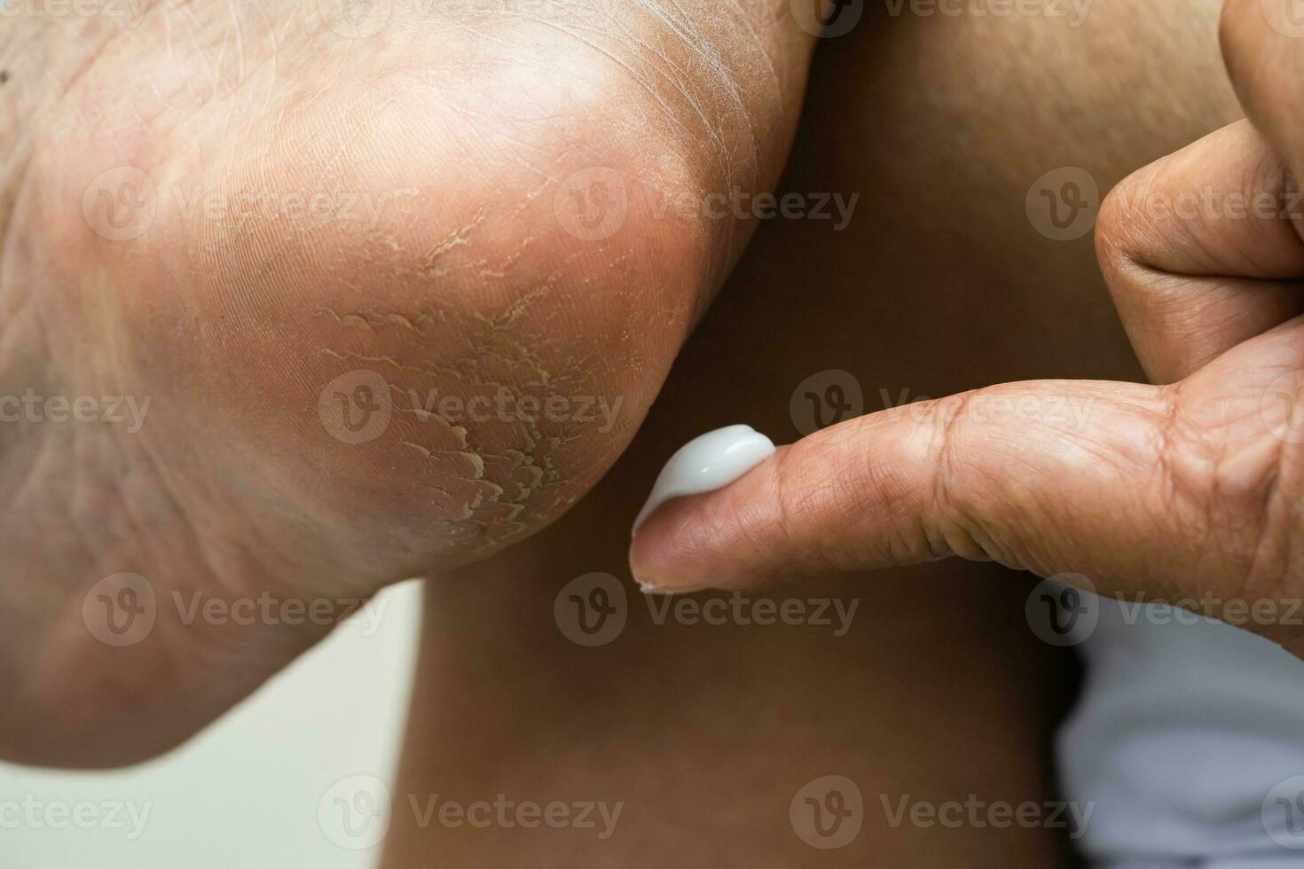 pés de cuidados de mulher com creme de pele de calcanhar rachado e seco em casa. foto