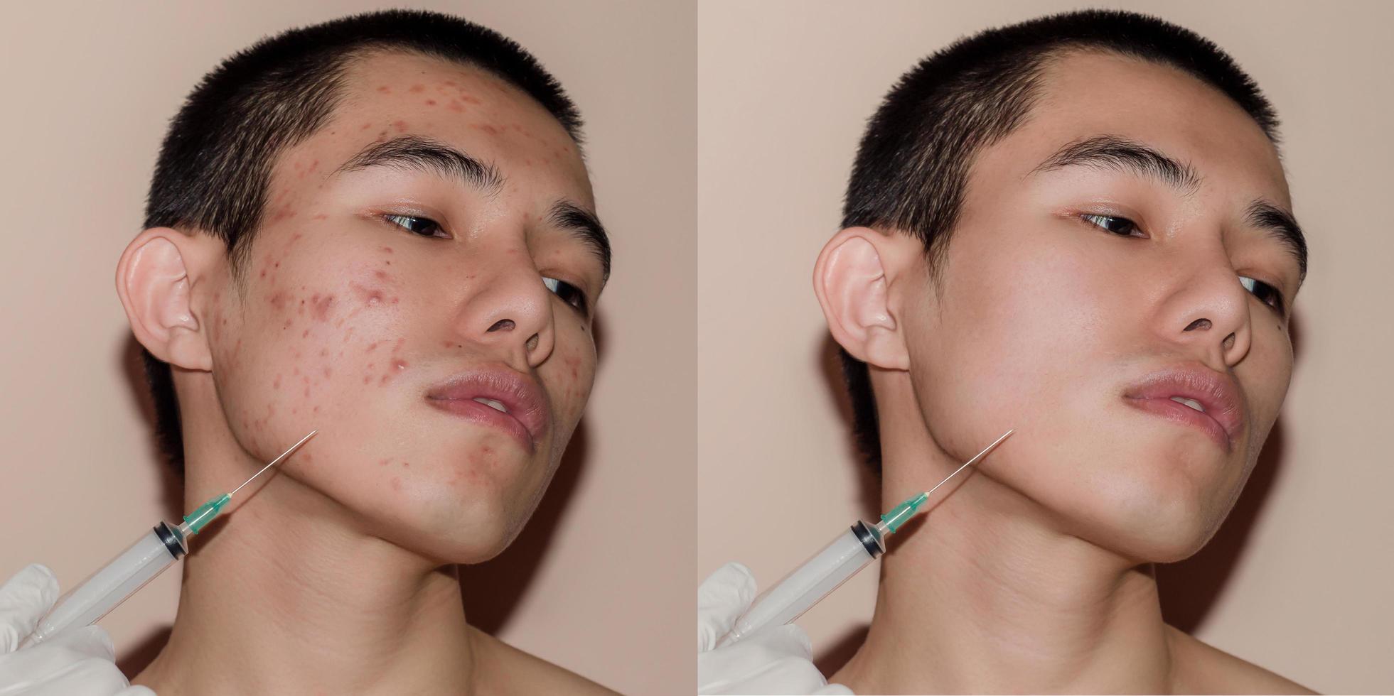 jovem com tratamento antes e depois de acne e espinhas. foto