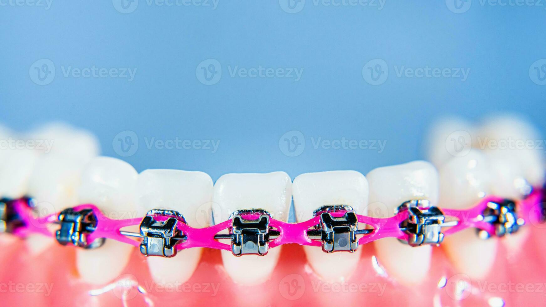 suspensórios estão colocada em a dentes dentro a artificial mandíbula contra uma luz azul fundo. macro fotografia foto