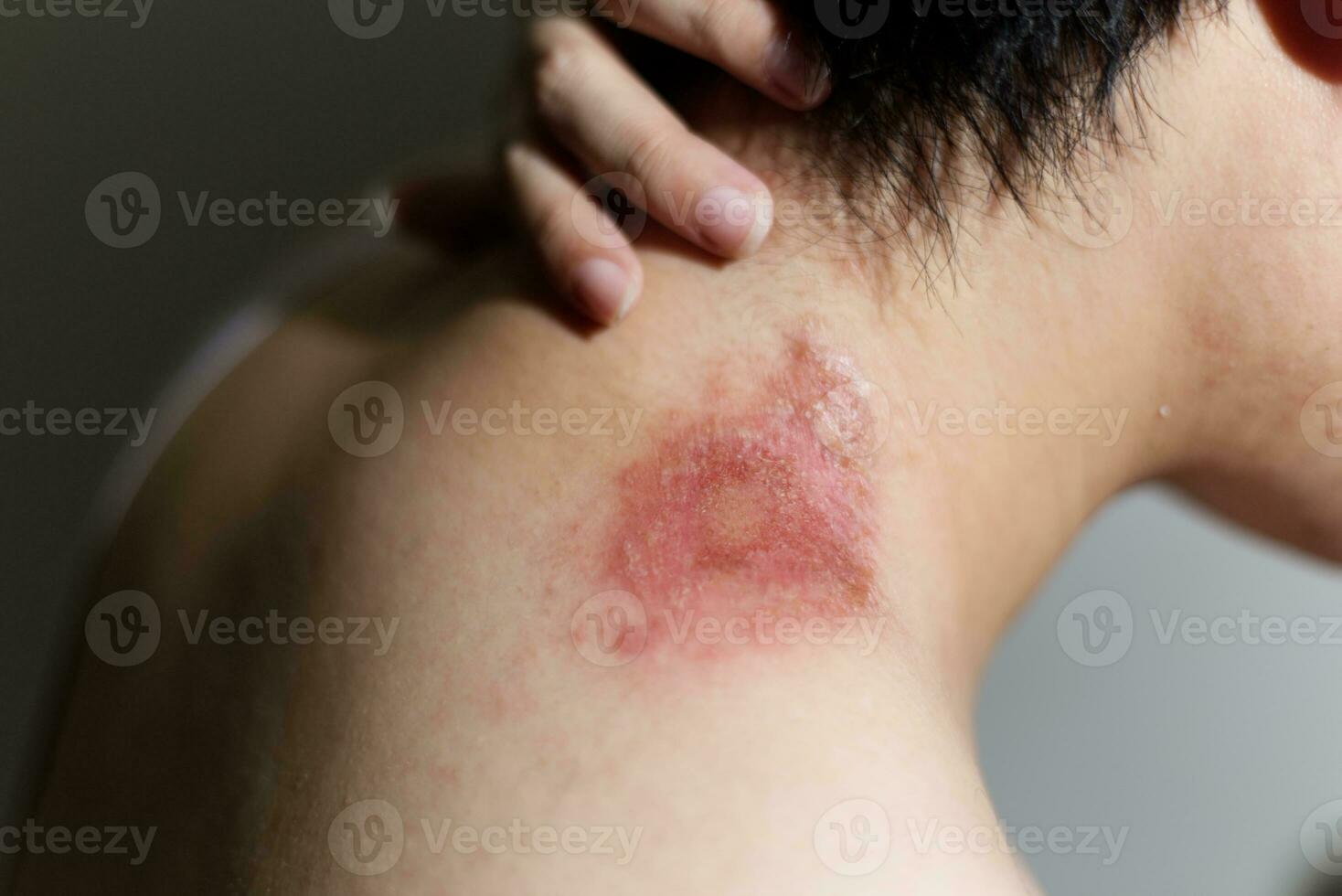 fechar acima sozinho mulheres com pele alergias , bolha , alérgico erupção cutânea em a ombro foto