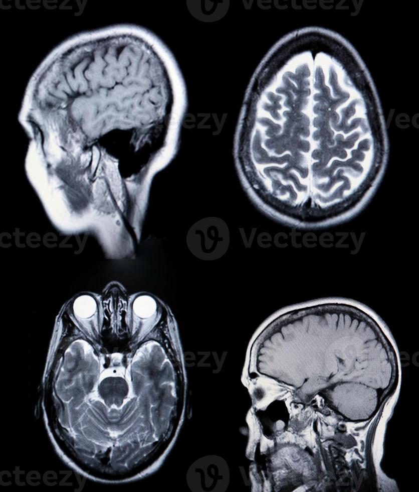 uma verdadeira ressonância magnética da vasculatura cerebral foto