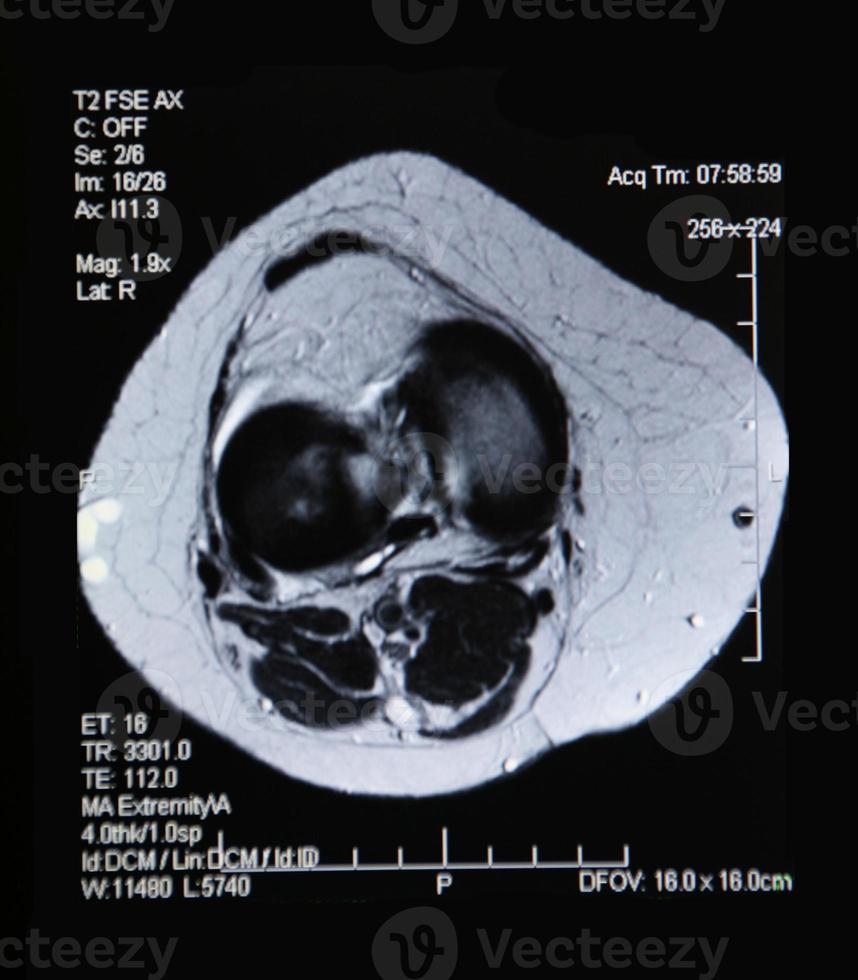 ressonância magnética do joelho foto