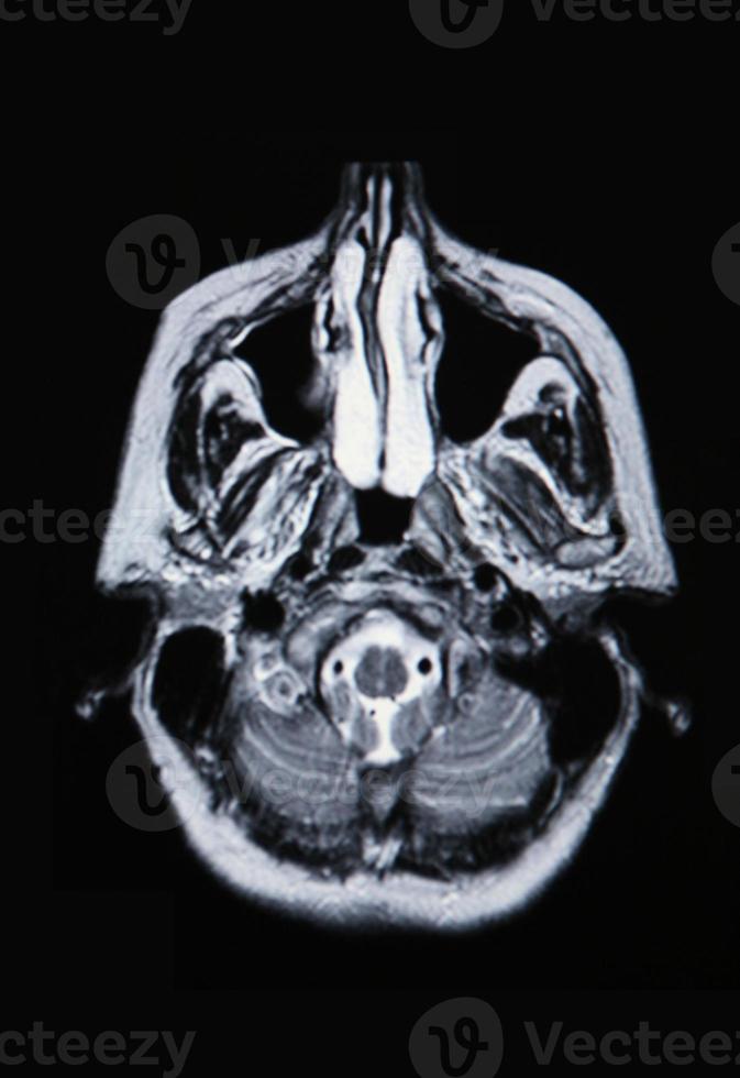 uma verdadeira ressonância magnética da vasculatura cerebral foto