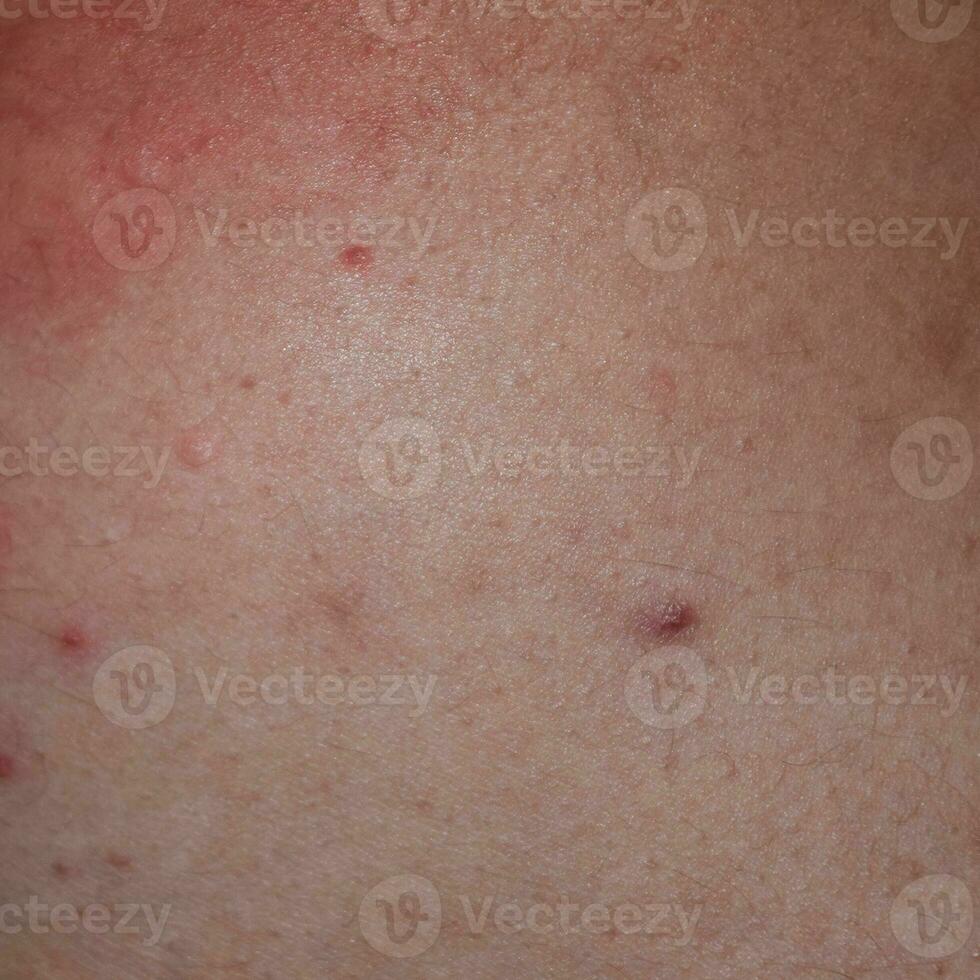 alergia pele costas e lados. alérgico reações em a pele dentro a Formato do inchaço e vermelhidão foto