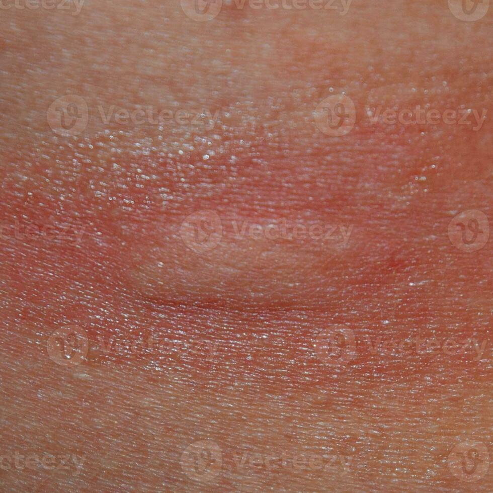 alergia pele. alérgico reações em a pele dentro a Formato do inchaço e vermelhidão foto
