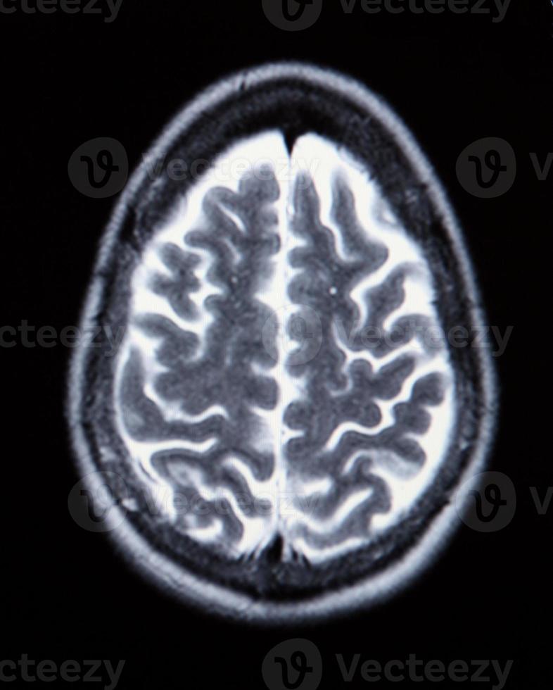 uma verdadeira ressonância magnética da vasculatura cerebral foto