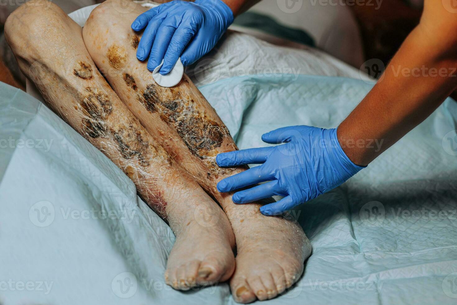 pele lesões em a perna. sintomas característica do a idosos início com uma vermelho erupção cutânea dentro uma pequeno círculo e espalhar para uma mais largo área. ampla crostas em a pernas. idosos Cuidado. consequências do diabetes foto