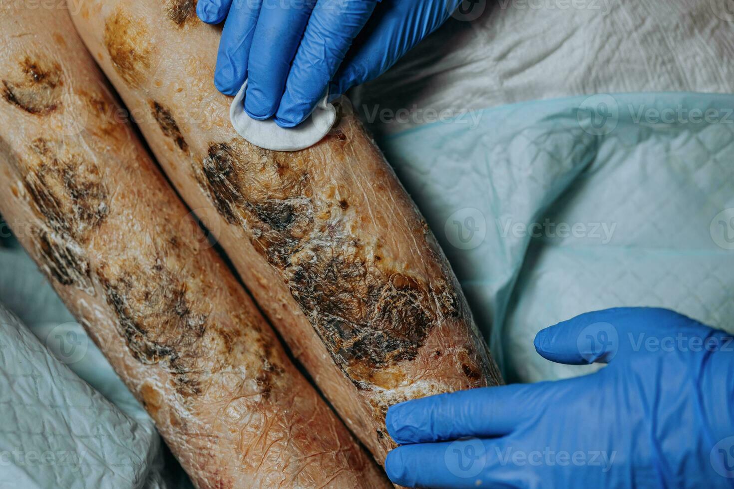 pele lesões em a perna. sintomas característica do a idosos início com uma vermelho erupção cutânea dentro uma pequeno círculo e espalhar para uma mais largo área. ampla crostas em a pernas. idosos Cuidado. consequências do diabetes foto