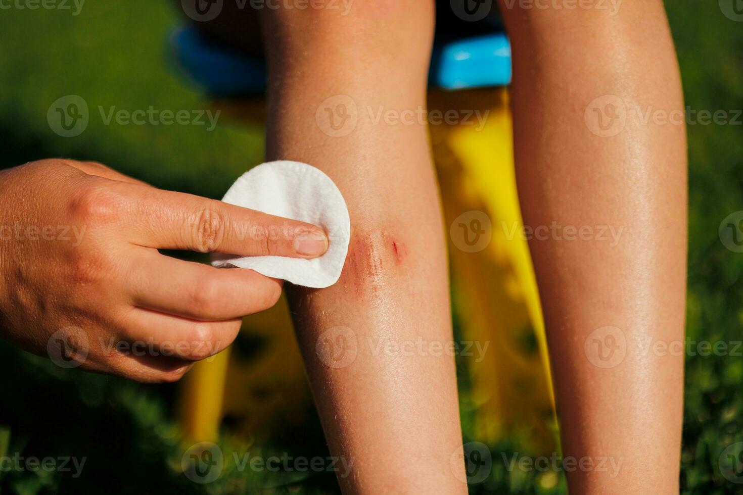 uma mulher mão cura uma criança ferida abaixo a joelho. uma criança senta em uma cadeira e verde Relva dentro a verão. tratamento do a ferimento. primeiro ajuda. fechar-se foto. foto