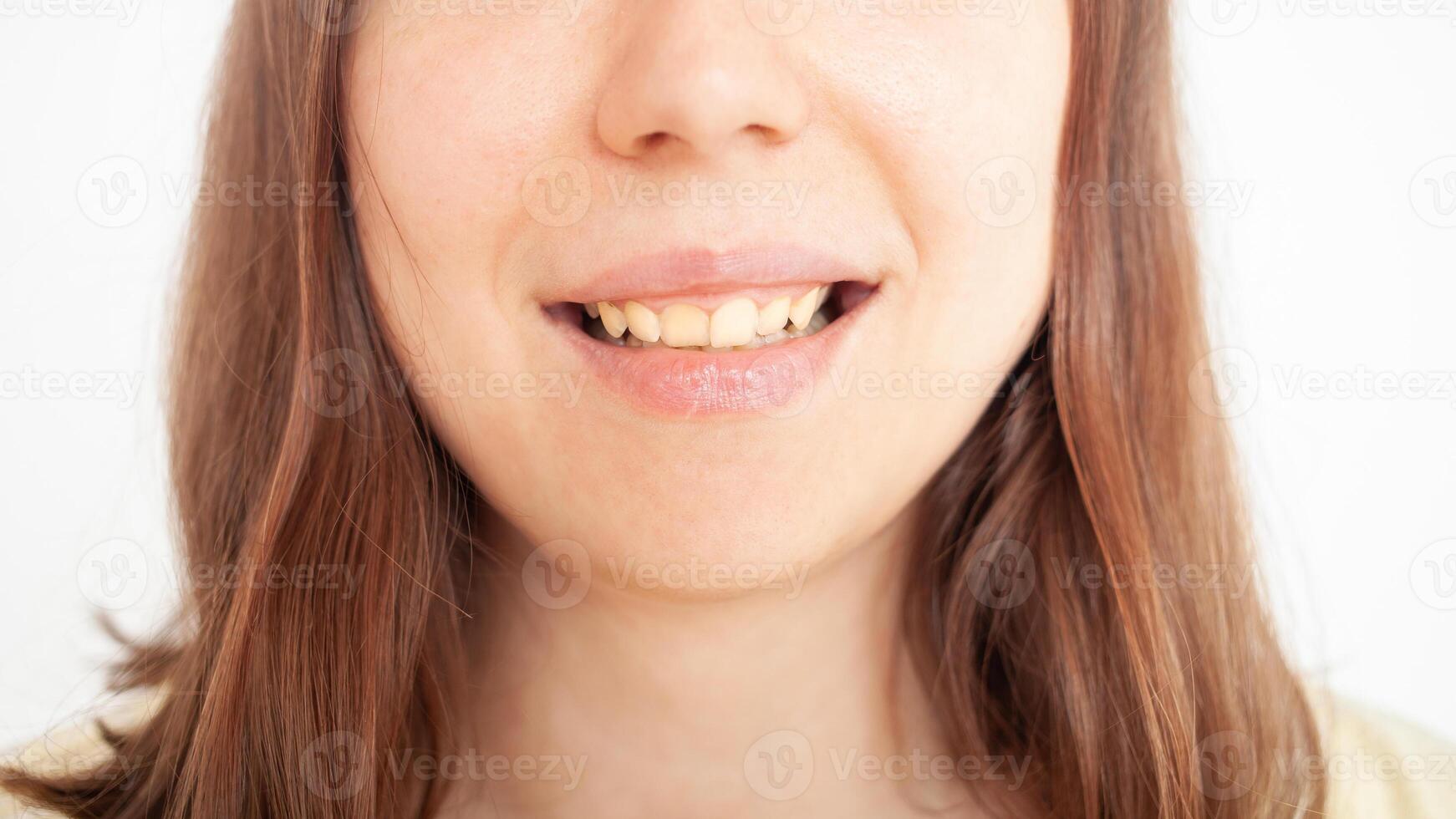 pessoa sorrisos, mostra dentes, amarelo placa, torto dentes, maloclusão. mulher mostra foto