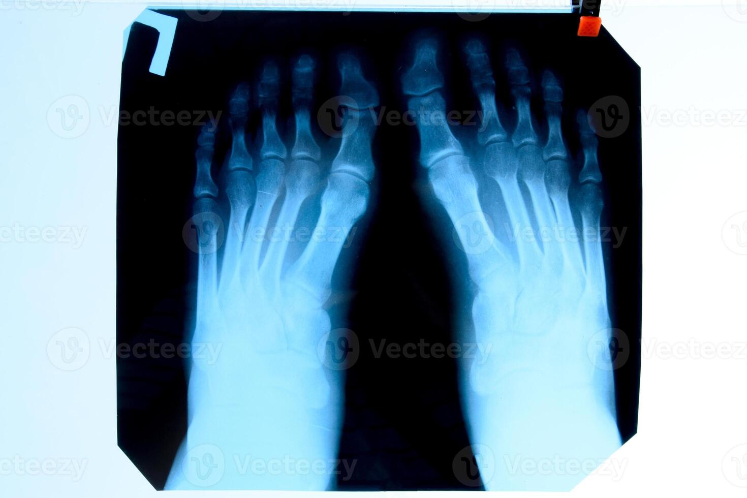 raio X do dedos do pé. pé em raio X. osso pesquisa foto