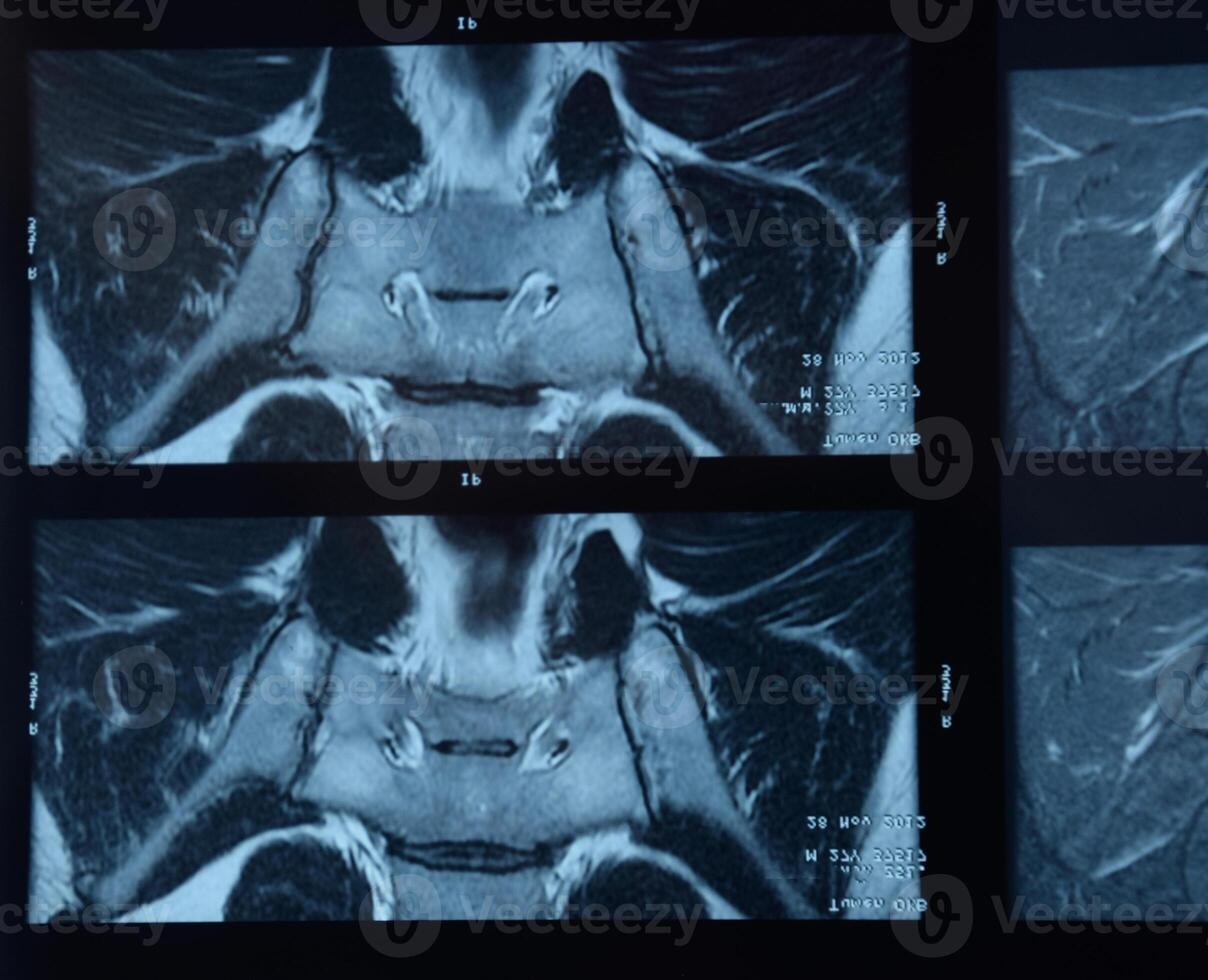 mri sacroilíaco articulação. estude do anquilosante espondiloartrite paciente. foto