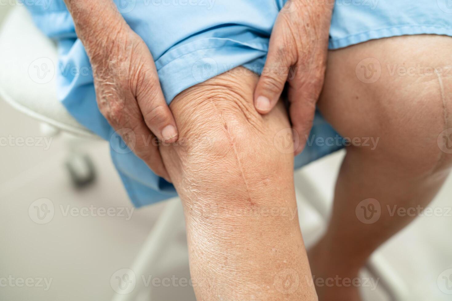 ásia idosos mulher paciente mostrar dela cicatrizes cirúrgico total joelho articulação substituição sutura ferida cirurgia artroplastia em cama dentro hospital. foto