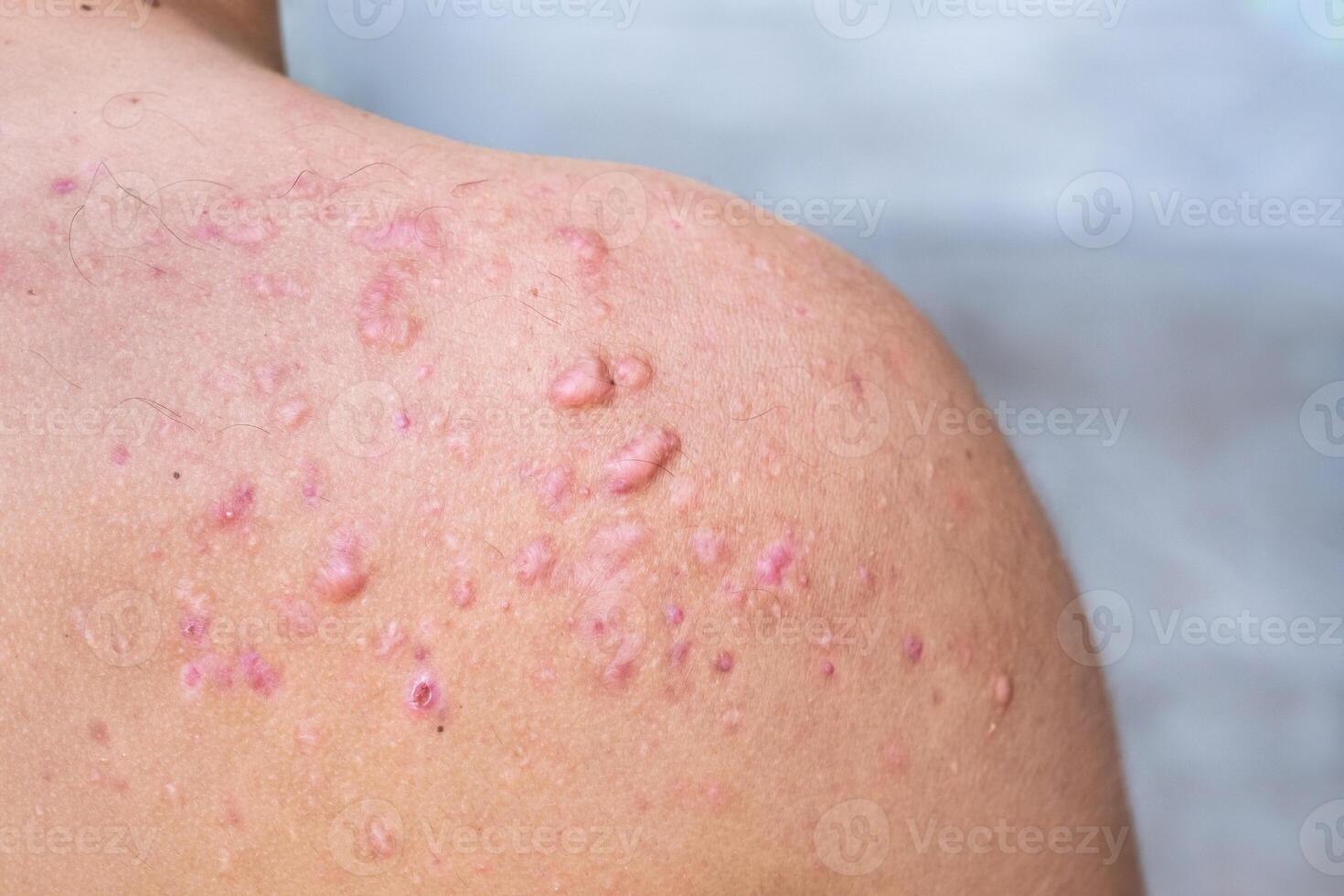 occipital acne dentro uma Adolescência Garoto curado, cicatrizes a partir de Adolescência acne em a ombros, pele infecções e alergias para a corpo do uma homem, cuidados de saúde e médico conceito foto