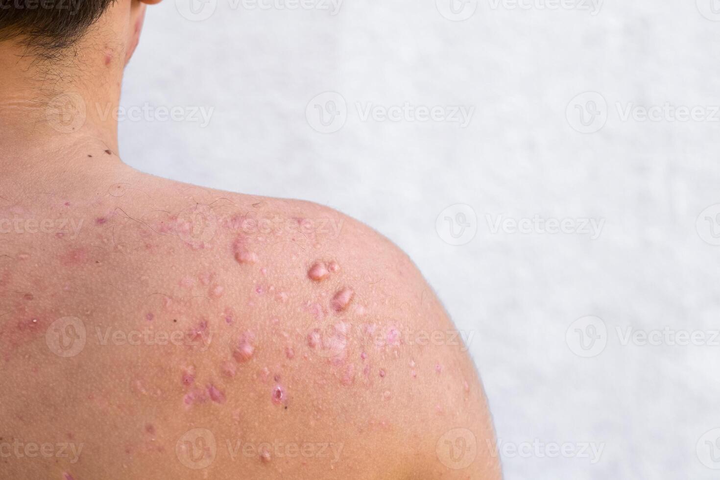 occipital acne dentro uma Adolescência Garoto curado, cicatrizes a partir de Adolescência acne em a ombros, pele infecções e alergias para a corpo do uma homem, cuidados de saúde e médico conceito foto