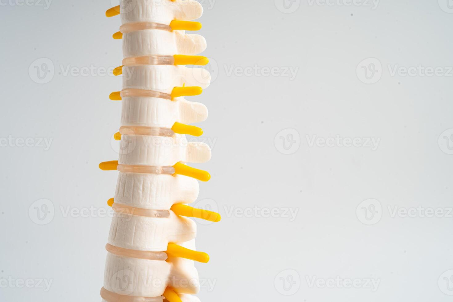lombar coluna vertebral deslocado hérnia disco fragmento, espinhal nervo e osso. modelo para tratamento médico dentro a ortopédico departamento. foto