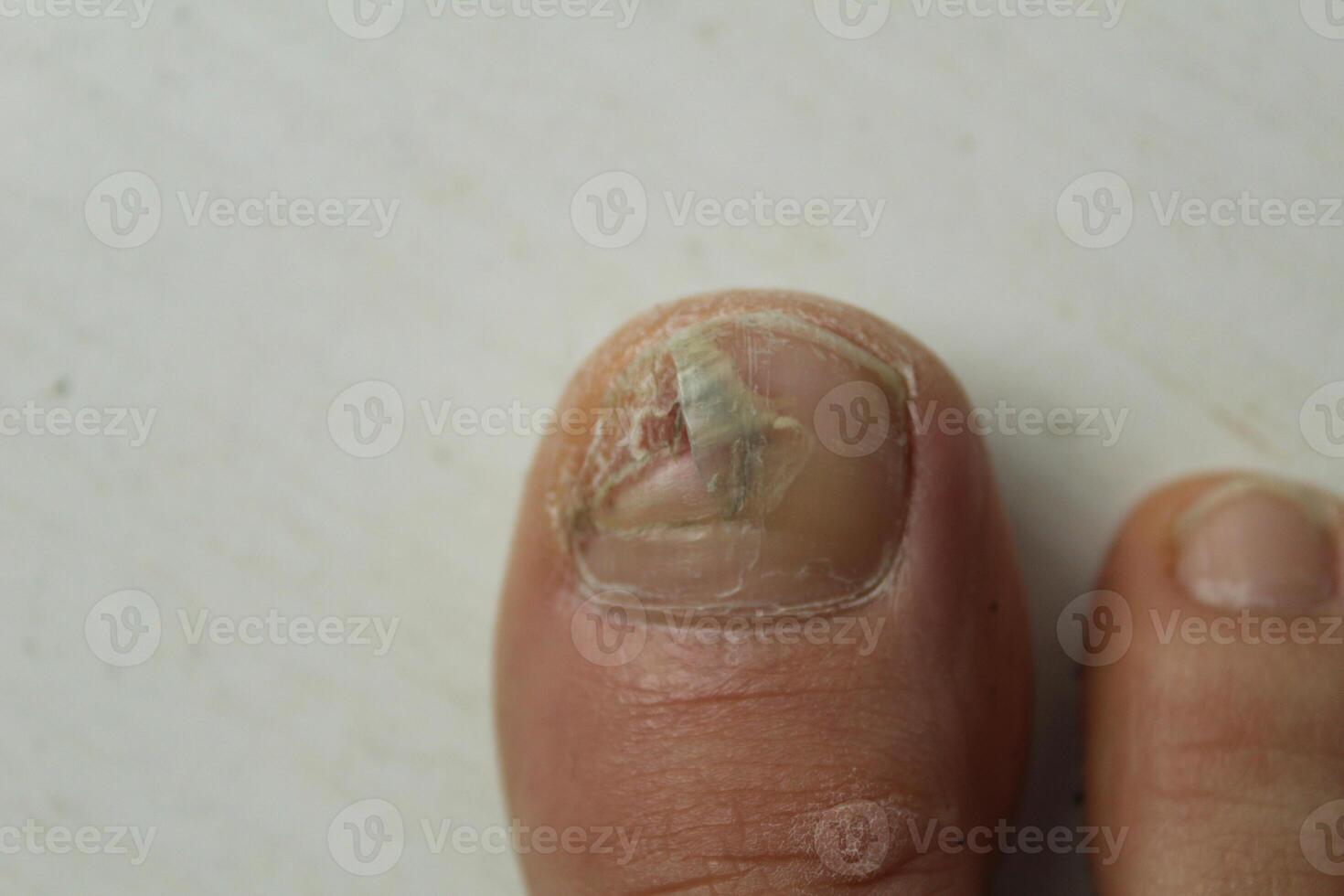 fungoso doenças do a unhas e pele do a pés fechar-se. podologia e tratamento opções para unha pratos. foto