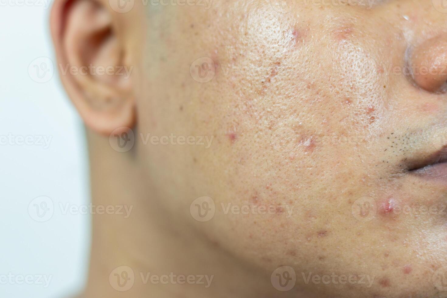 pele problemas. problema do inflamado acne em a face. inflamado acne consiste do inchaço, vermelhidão, e poros este estão severamente entupido com bactérias, óleo, e morto pele células. foto