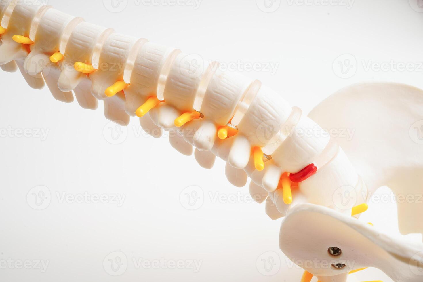 espinhal nervo e osso, lombar coluna vertebral deslocado hérnia disco fragmento, modelo para tratamento médico dentro a ortopédico departamento. foto