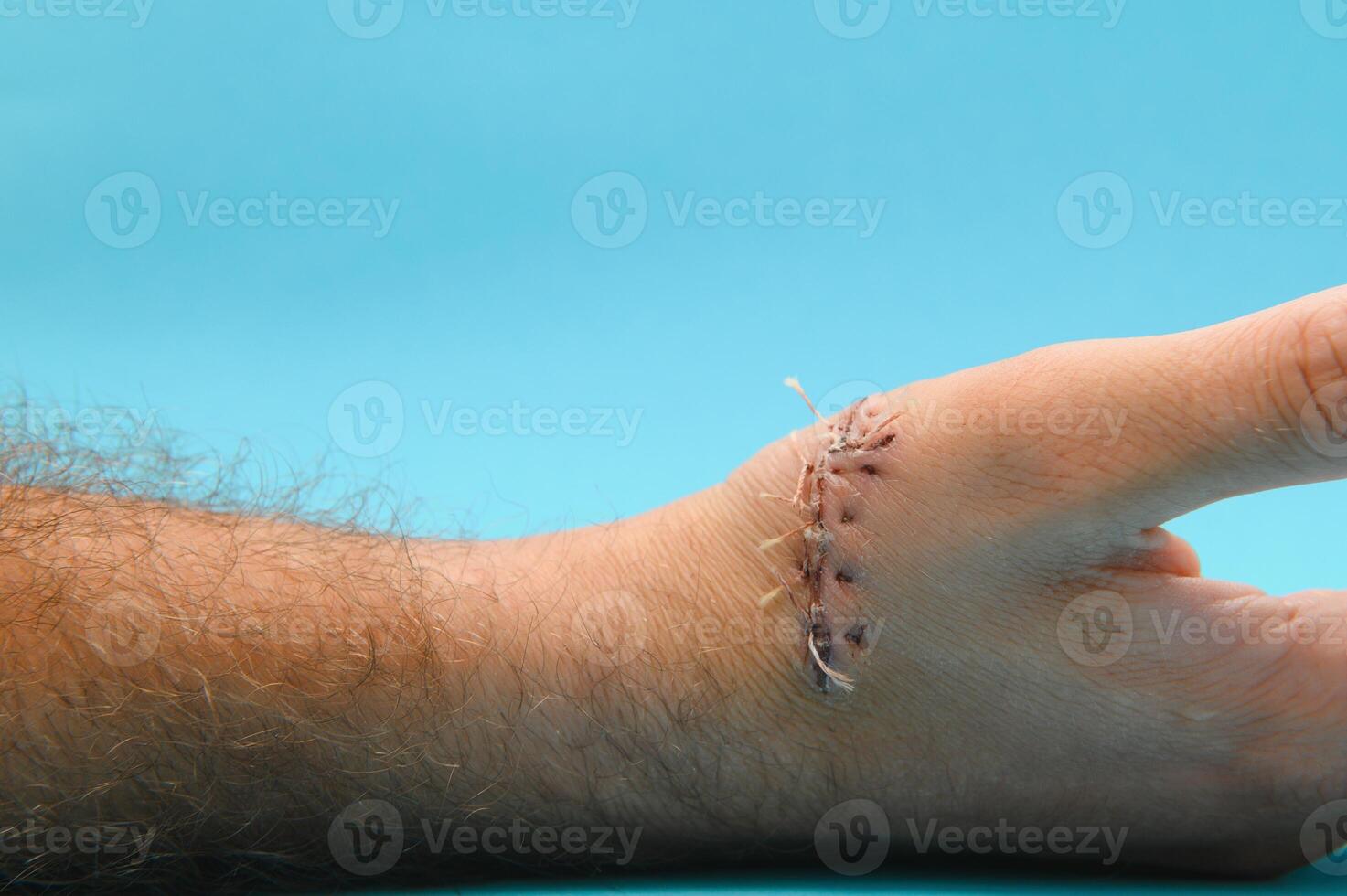 sutura ferida em mão, dor do acidente conceito foto