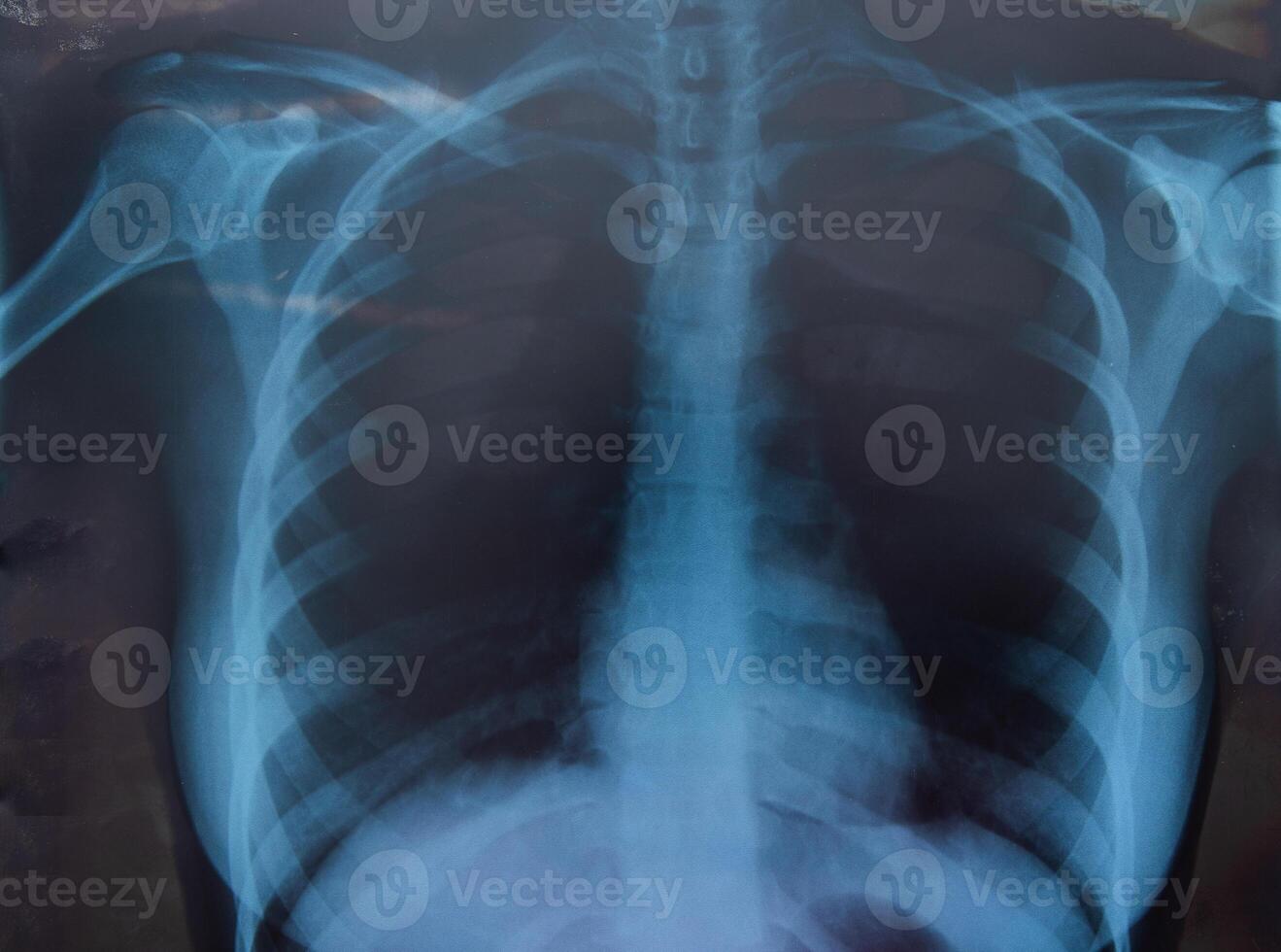 mulher raio X para peito e pulmões exame foto