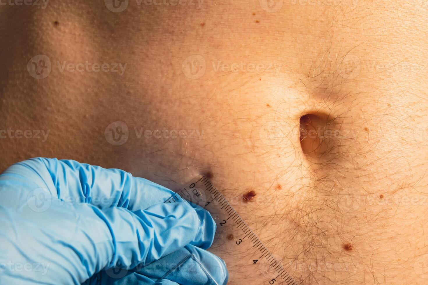 dermatologista verificação tamanhos do masculino marcas de nascença com governante. médico examinando comprimento e largura do benigno toupeiras em homem pele pigmentação. foto