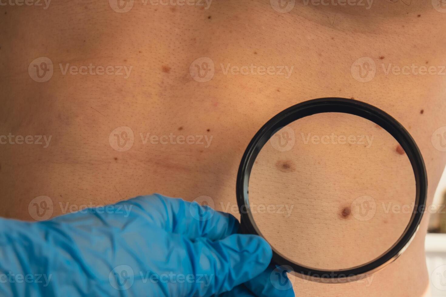 irreconhecível dermatologista examinando pacientes marca de nascença com ampliação vidro dentro clínica. toupeira dermatoscopia, preventivo do melanoma. verificação benigno moles. pele anormalidades Cuidado conceito. foto