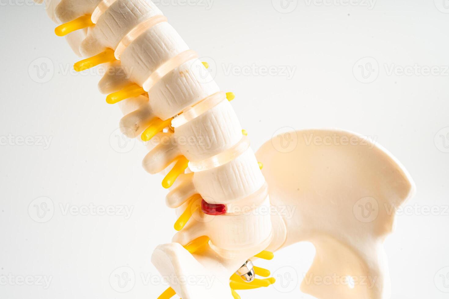 lombar coluna vertebral deslocado hérnia disco fragmento, espinhal nervo e osso. modelo para tratamento médico dentro a ortopédico departamento. foto