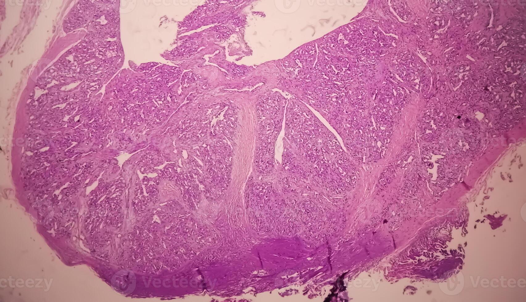 histologia, peritoneal inclusão cisto. paraovariano cistos, hidrossalpinge e nota baixa cístico mesotelioma estão geralmente considerado dentro a diferencial diagnóstico do fotos. foto