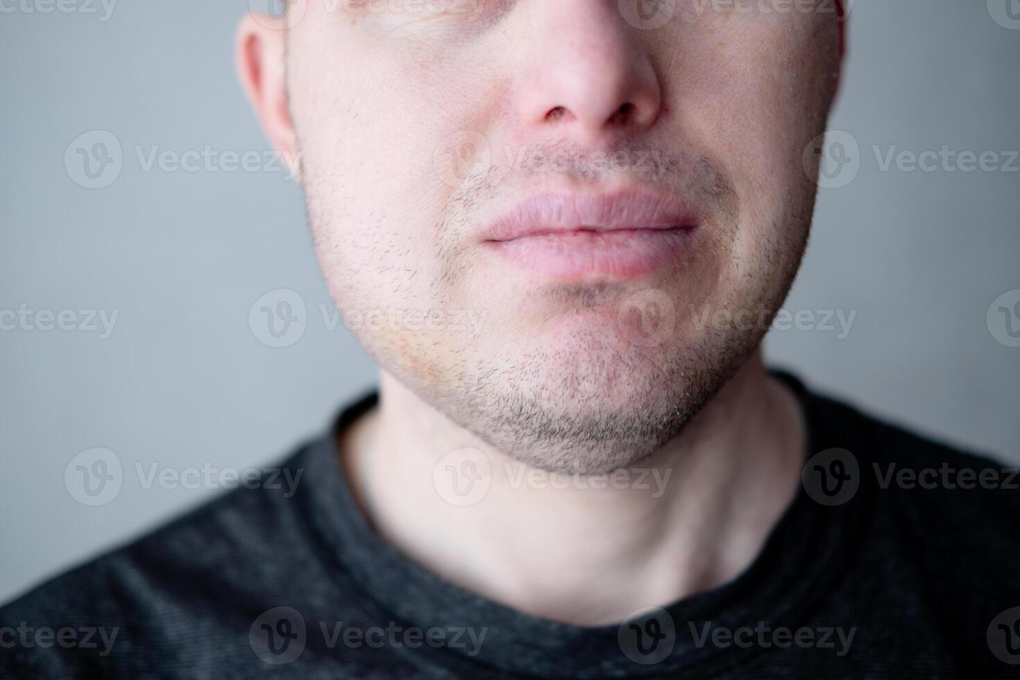 inchado parte do a face depois de a remoção do sabedoria dentes dentro uma homem, fechar-se foto