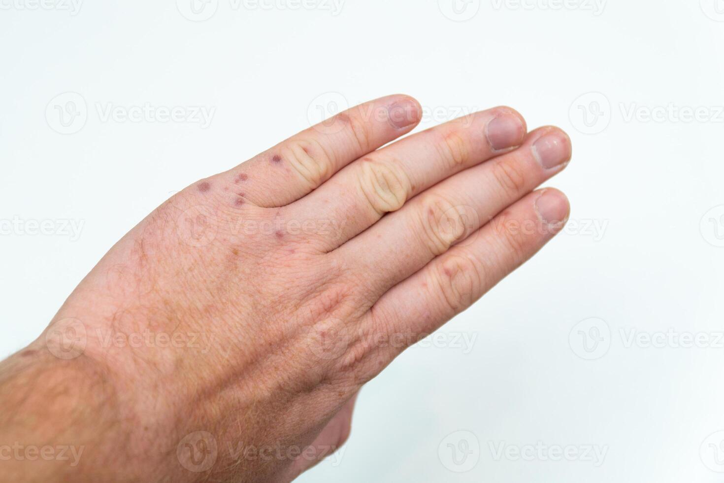 doloroso irritação na pele, vermelho bolhas em uma do homem braço. humano mãos com dermatite, alergia irritação na pele. enterovírus. coxsackie vírus. alérgico erupção cutânea em a mãos do a adulto homem foto