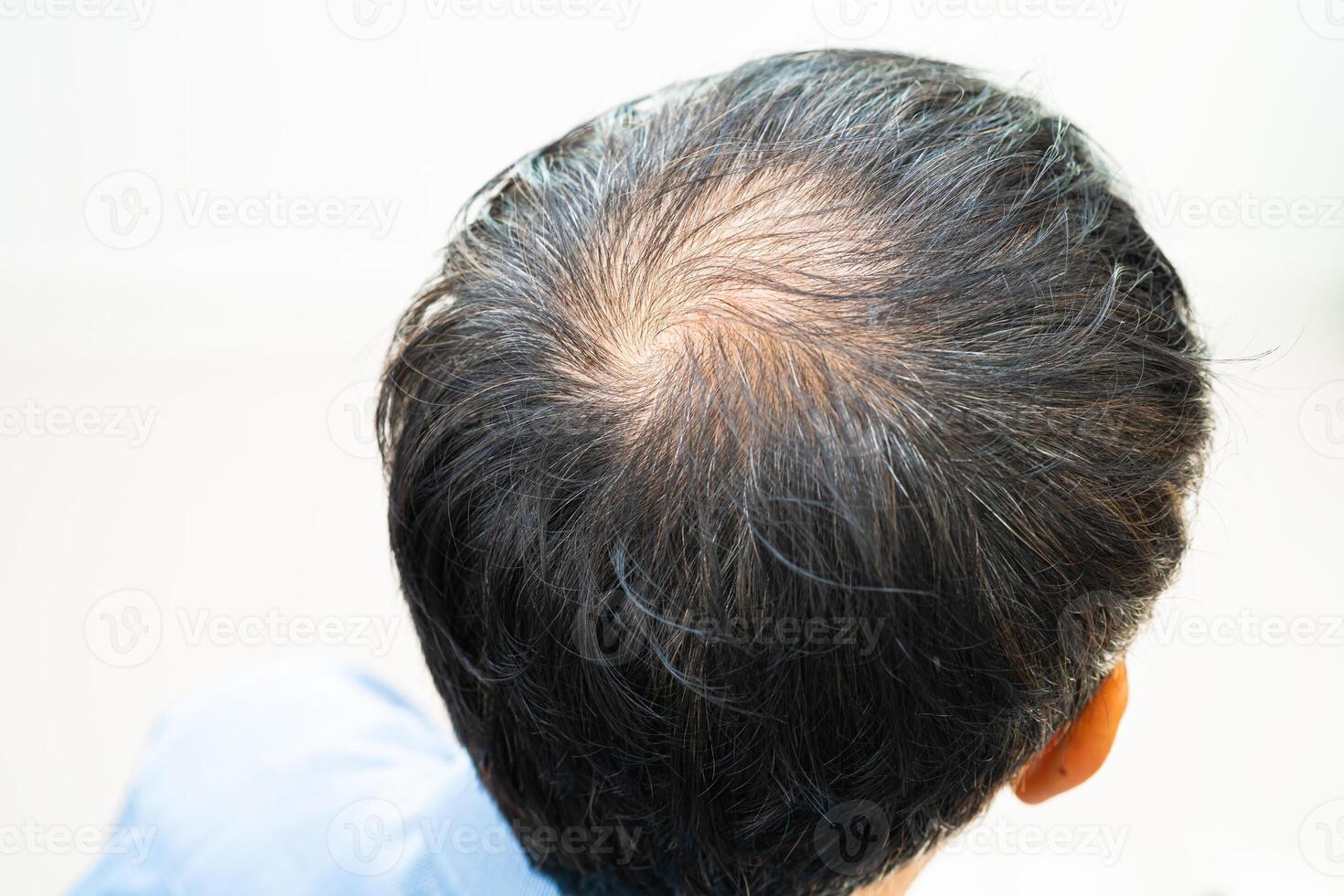 careca na cabeça do meio e começar sem perda de cabelo glabro de homem de escritório ativo inteligente de negócios asiáticos maduros. foto