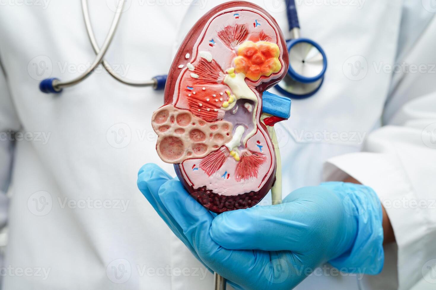 crônica rim doença, médico com modelo para tratamento urinário sistema, urologia, estimado glomerular filtração taxa egfr. foto