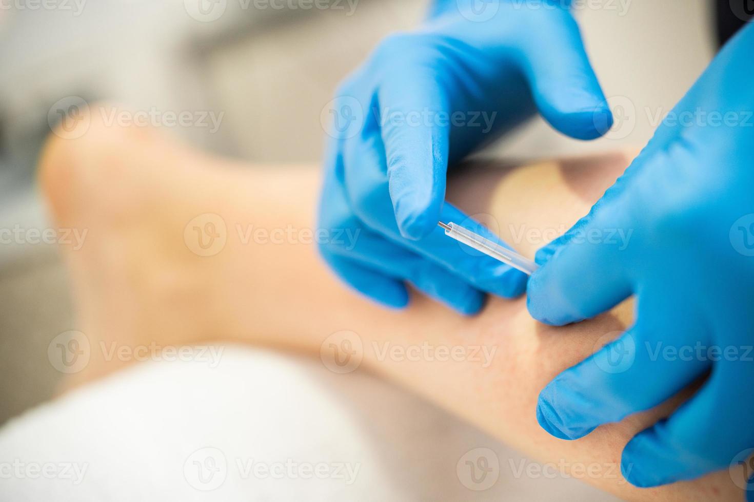 mãos de fisioterapeuta fazendo uma agulha seca foto