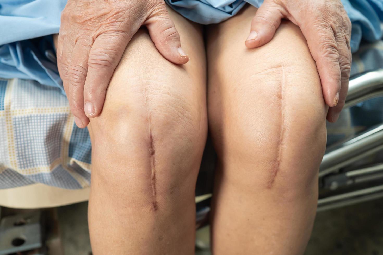 paciente asiático sênior ou idosa senhora idosa mostra suas cicatrizes artroplastia cirúrgica de artroplastia de cirurgia de ferida de sutura de substituição de articulação total do joelho na cama na enfermaria do hospital, conceito médico forte e saudável. foto