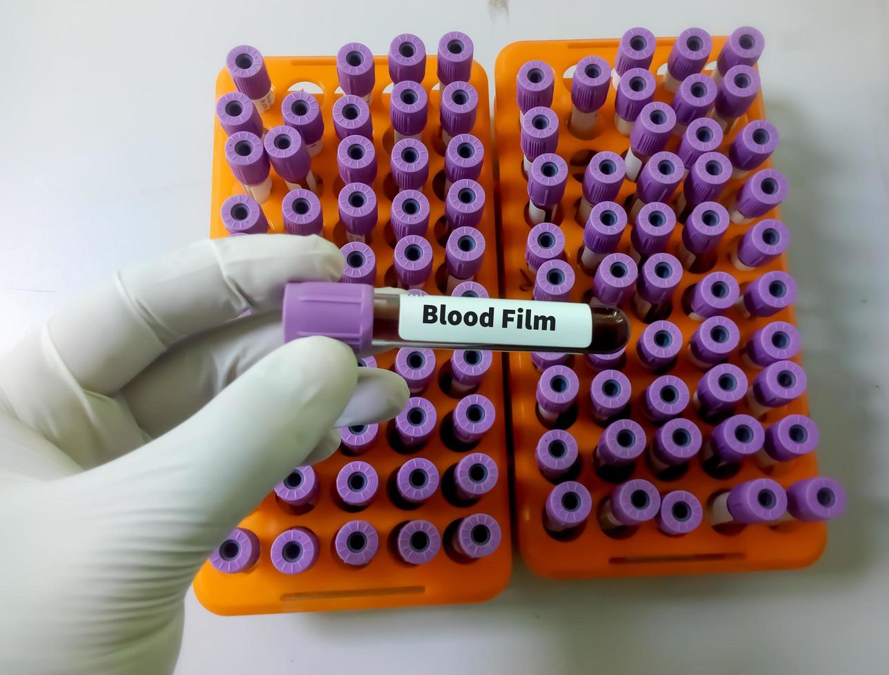 amostra de sangue em tubo lavanda para exame de esfregaço em laboratório de hematologia. fechar-se. conceito de teste médico. foto