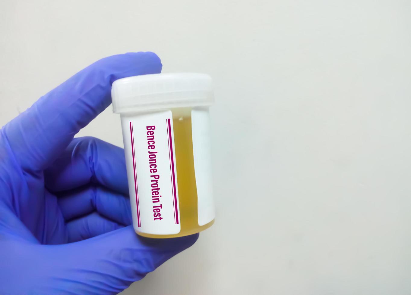 amostra de urina para teste de proteína de bence jonce em laboratório médico. diagnóstico de mieloma múltiplo foto