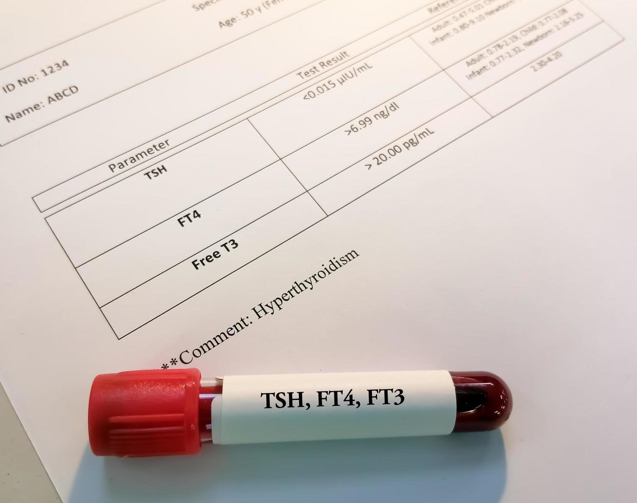 amostra de sangue com relato anormal de hormônio tireoidiano isolado. O hipertireoidismo ocorre quando a glândula tireoide produz uma quantidade excessiva do hormônio. foto