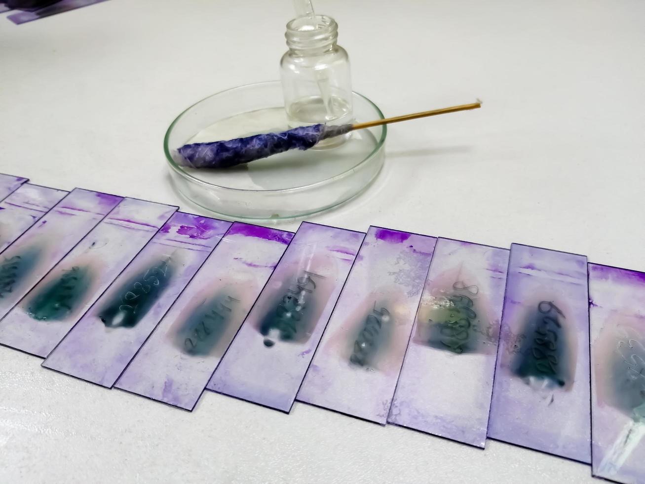 lâmina de vitral hematológica e relatório isolado na mesa com microscópio em laboratório. foto